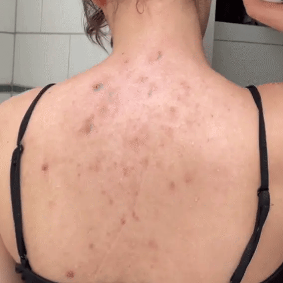 Afrodita Back Acne Spray