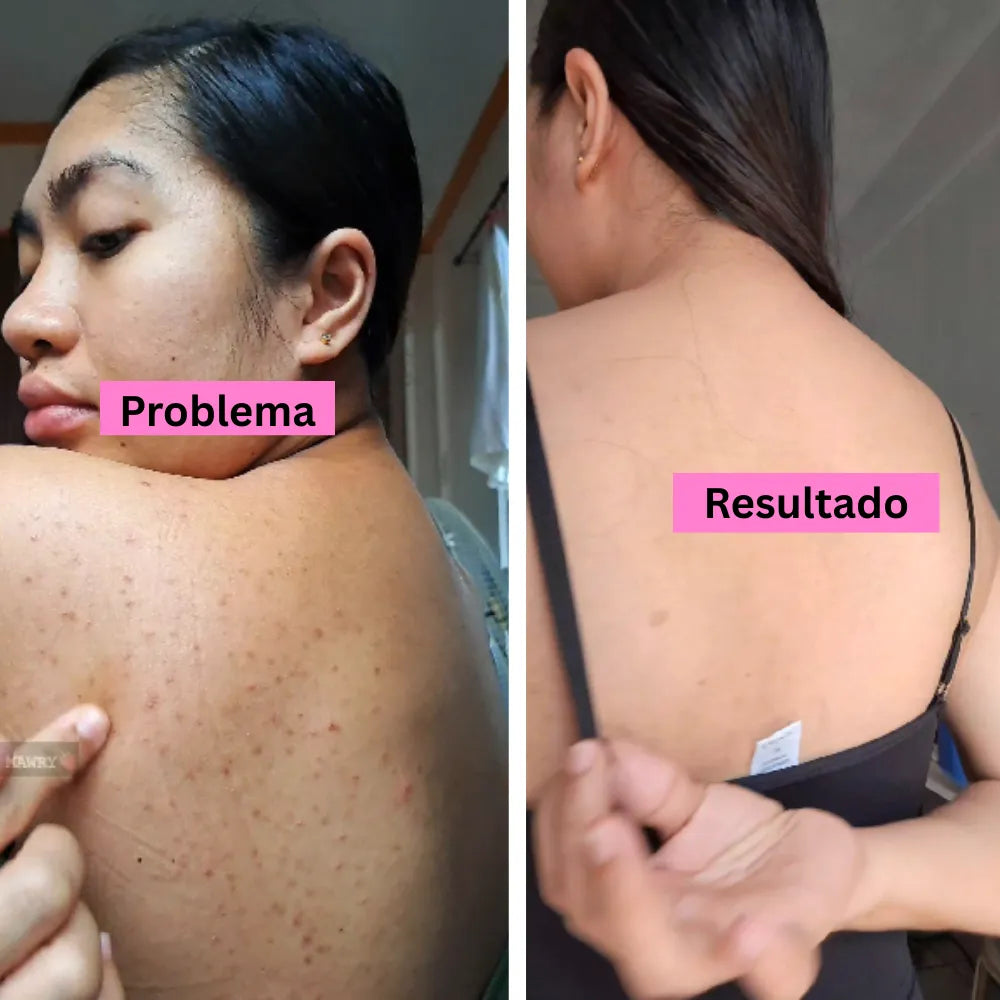 Afrodita Back Acne Spray