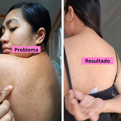 Afrodita Back Acne Spray